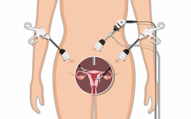 Laparoscopic Hysterectomy